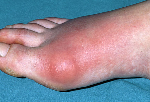 Gout (image for) Gout